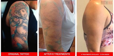 Rethink | Before and After Laser Tattoo Removal Photos