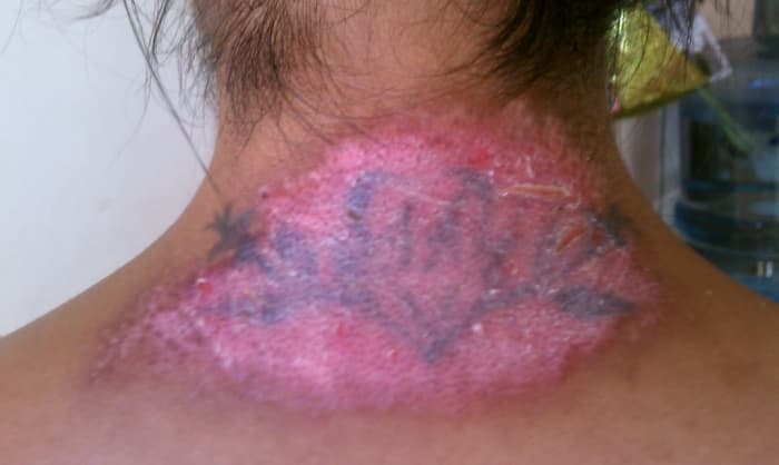 Laser Tattoo Removal vs Tattoo Removal Creams - Whats the verdict?