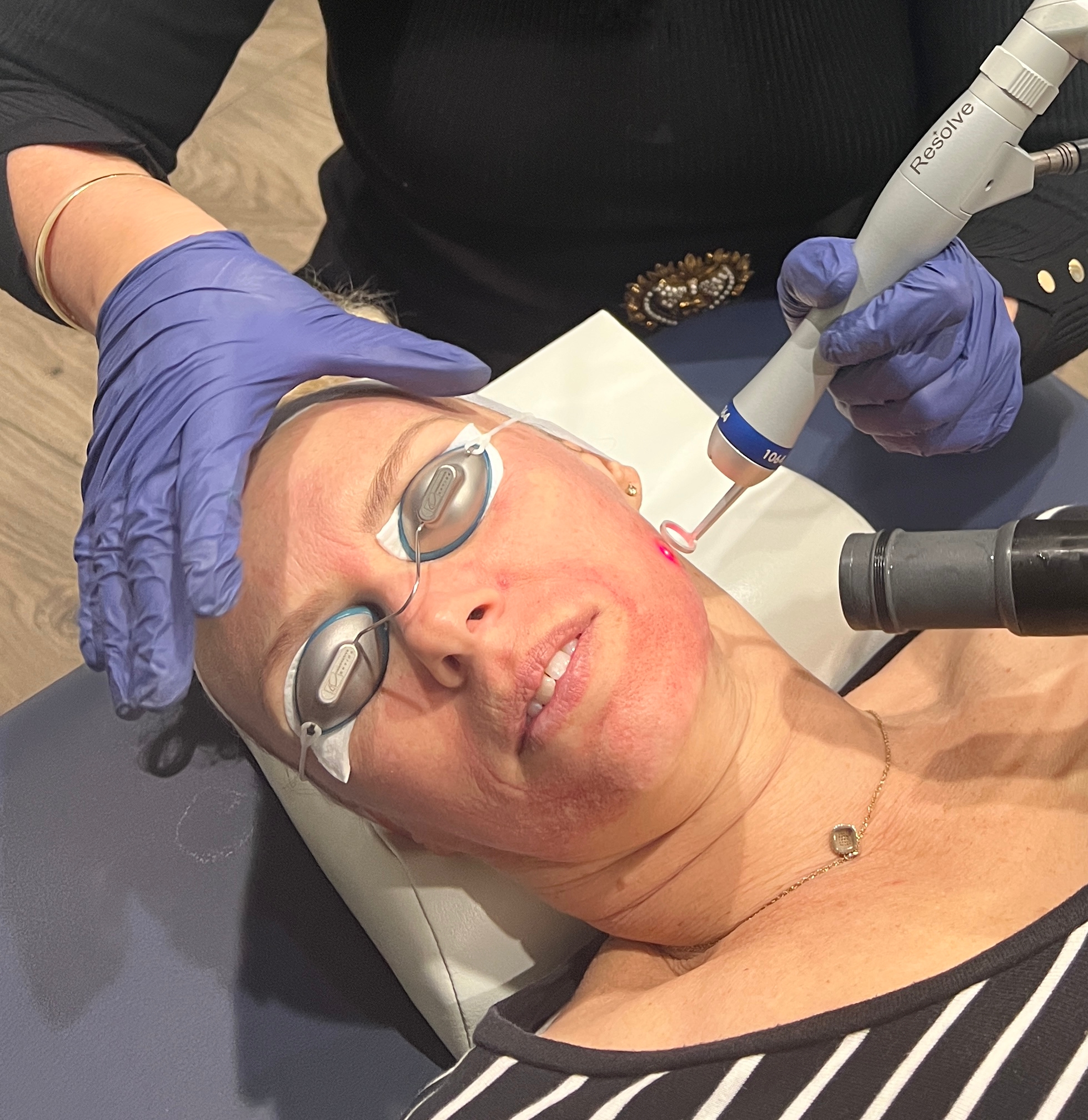 resolve laser treatment fractional-laser