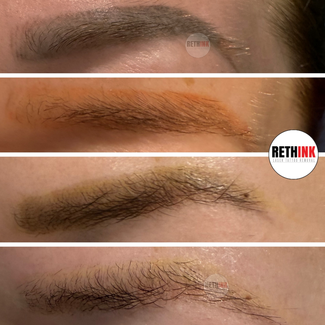 cosmetic eyebrow tattoo removal